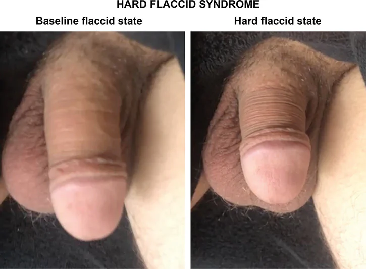 Normal Flaccid Penis vs Hard Flaccid Penis