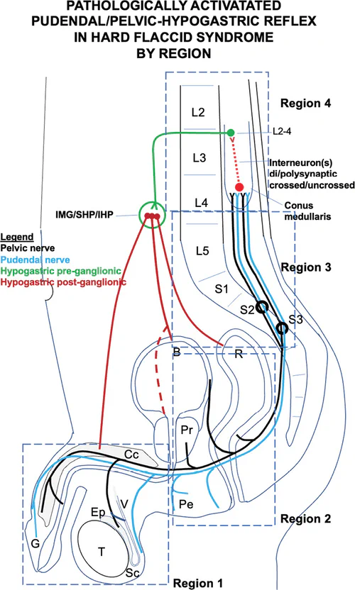 Goldstein&rsquo;s Hard Flaccid Syndrome Pathology Graphic